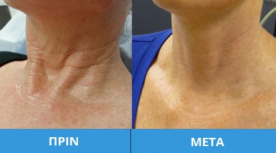 Μεσoθεραπεία Πρoσώπου – PRP