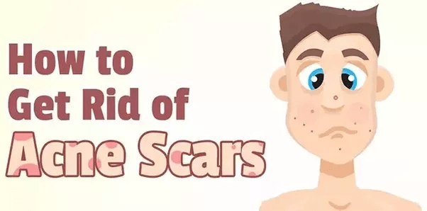 Διώξτε τα σημάδια της ακμής