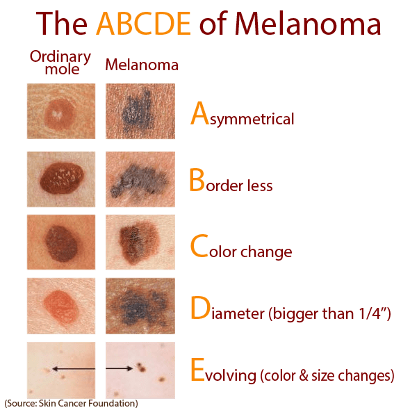 Nevi - Dermatoscopie computerizată