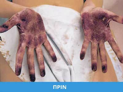 Botox / Dysport – Hyperhidrosis