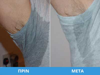 Botox / Dysport – Hyperhidrosis